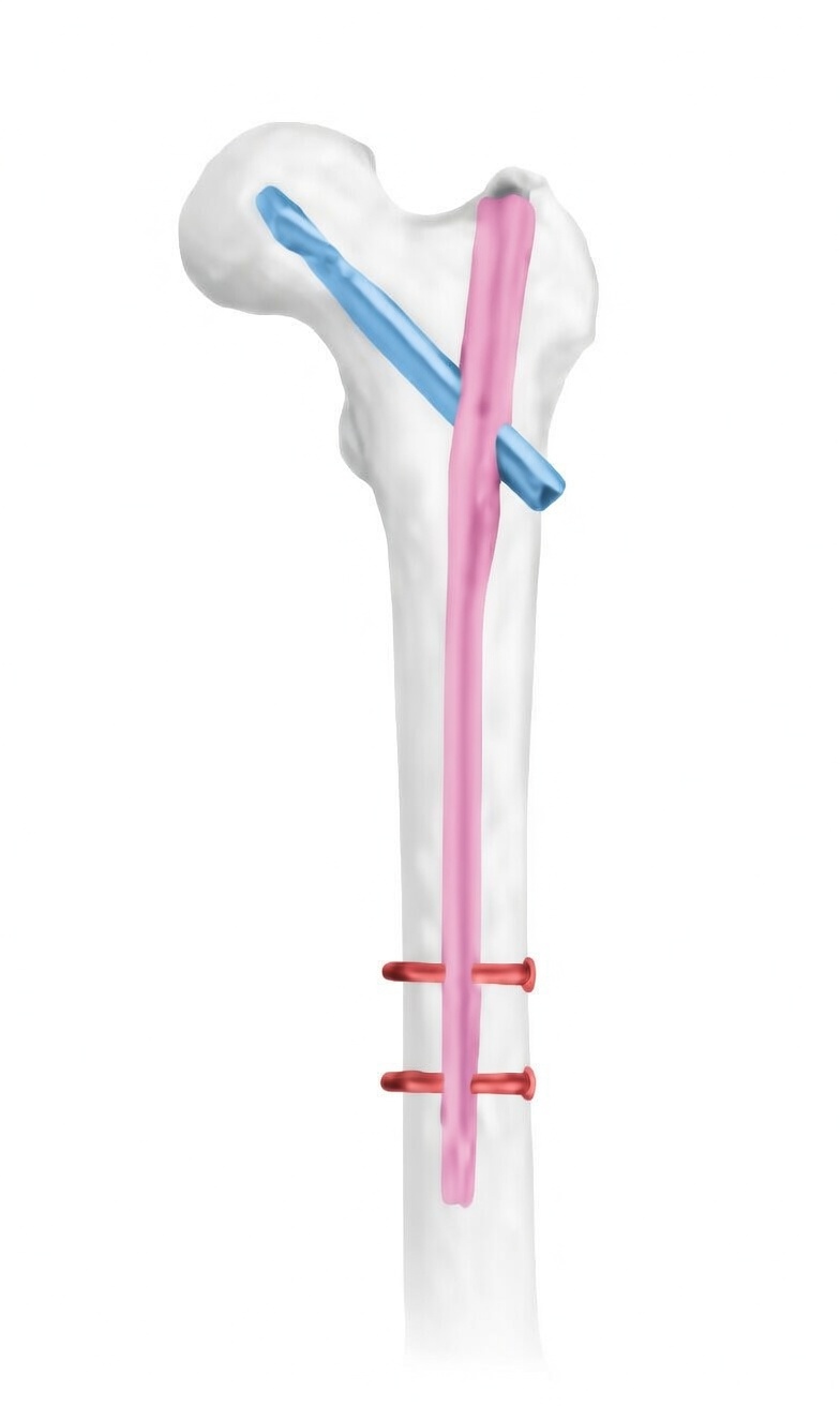 Проксимальний стегновий стрижень, антиротаційний, універсальний (PFNA) (Jinlu)